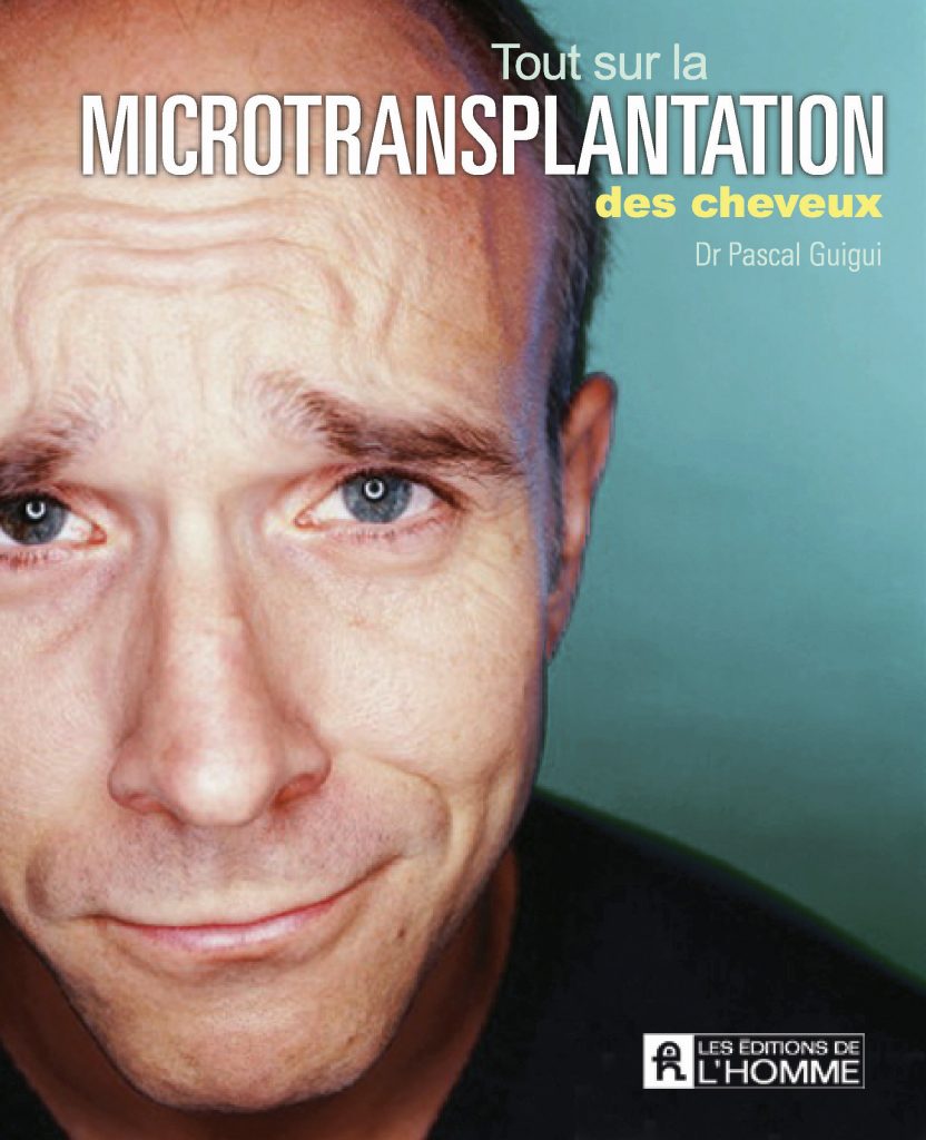 Photo de la couverture du livre "tout sur la microtransplantation des cheveux" par le docteur Pascal Guigui, spécialiste de la greffe de cheveux