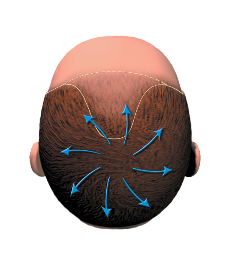 Greffe de cheveux : la technique de l'implantation capillaire