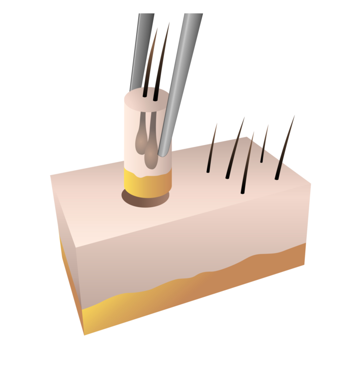 Illustration d'un extraction d'un follicule capillaire